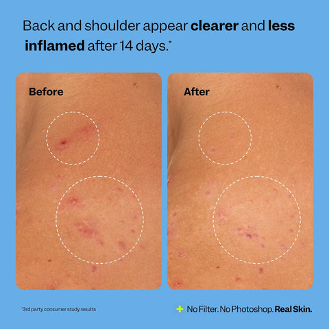 Peach Slices Breakout Banisher Niacinamide Beta-Glucon support calm skin
